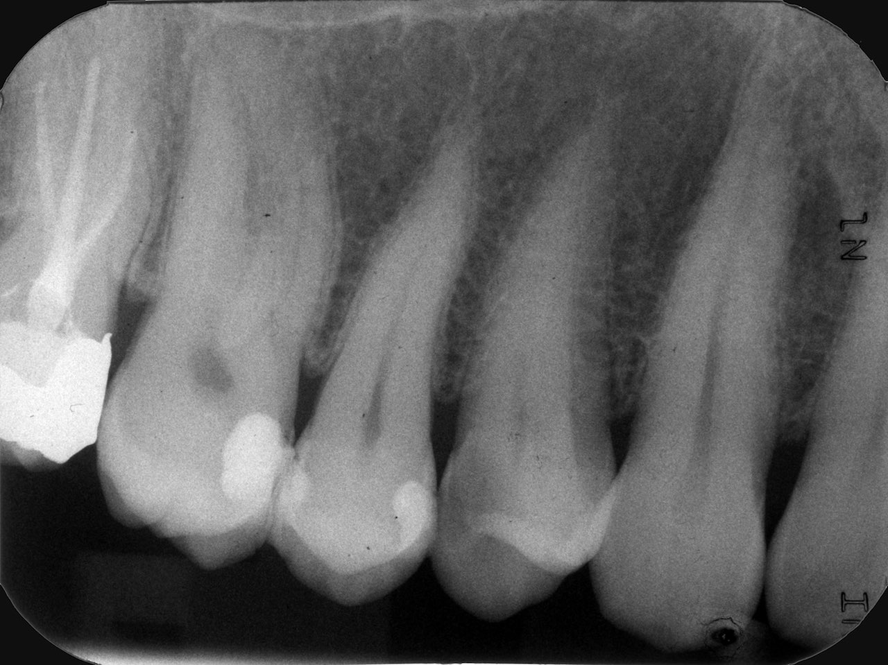 Abb. 1: Zahnfilm eines 43-jährigen Patienten, 1. Quadrant. Auffällig war die Approximalkaries an Zahn 14 distal.
