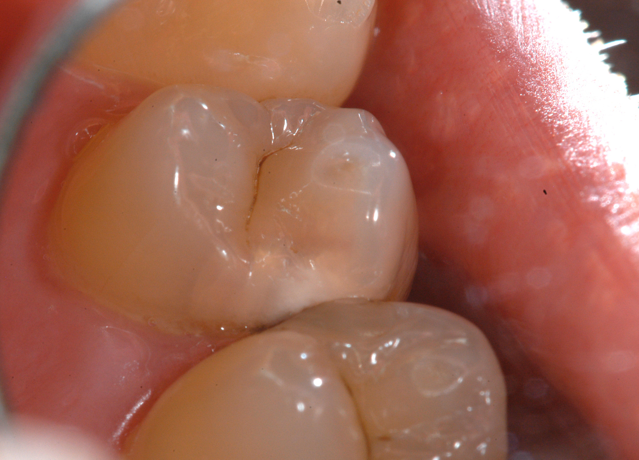 Abb. 2: Auch klinisch war die Approximalkaries an Zahn 14 distal 