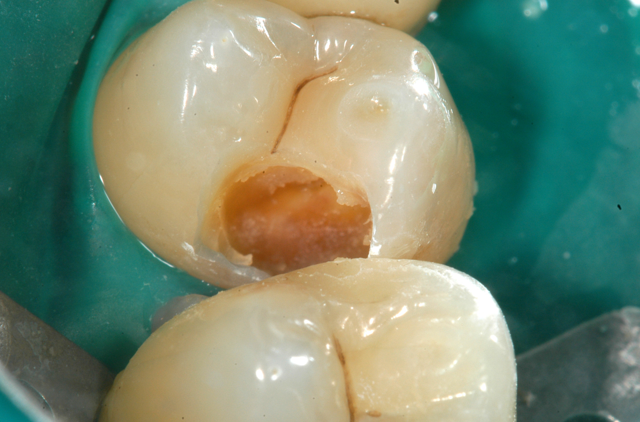 Abb. 4: Primärpräparation und unvollständige Kariesexkavation an Zahn 14