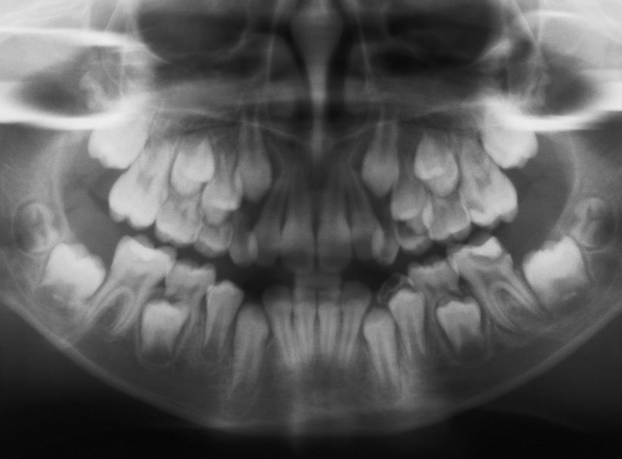 Abb. 3c Als ursächlich wurde klinisch-röntgenologisch der kariöse Zahn 36 mit einer apikalen Parodontitis identifiziert. Aufgrund der Dringlichkeit erfolgte die stationäre Aufnahme der Patientin zur antibiotischen Therapie und zur Entfernung des Zahnes 36 in Allgemeinanästhesie.