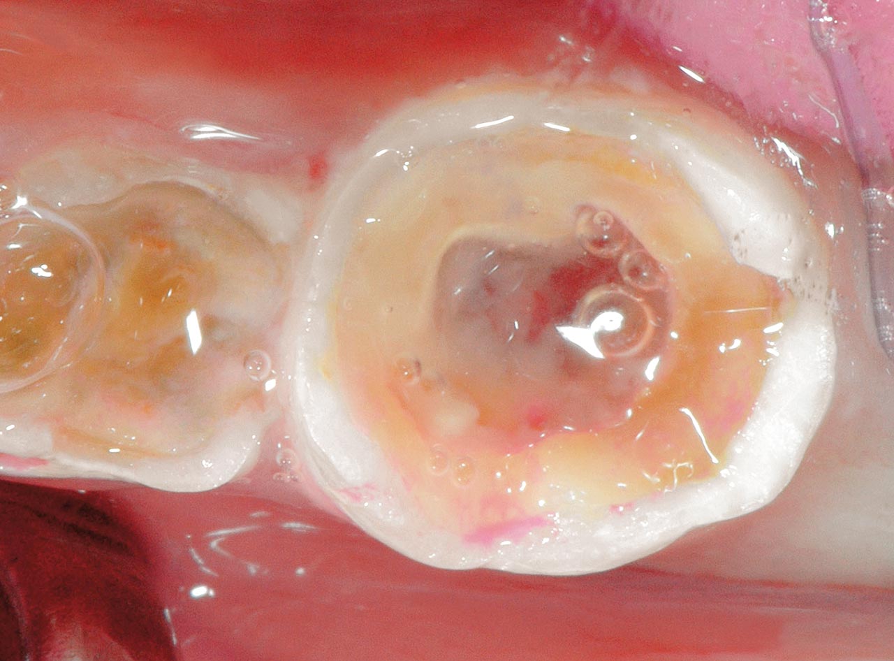 Abb. 4a und b: Das Belassen trepanierter Milchzähne – hier Zahn 75 – ist immer wieder Anlass für akute Beschwerden. Daher sind Milchzähne, die aufgrund akuter pulpitischer Beschwerden trepaniert wurden, zeitnah zu entfernen.