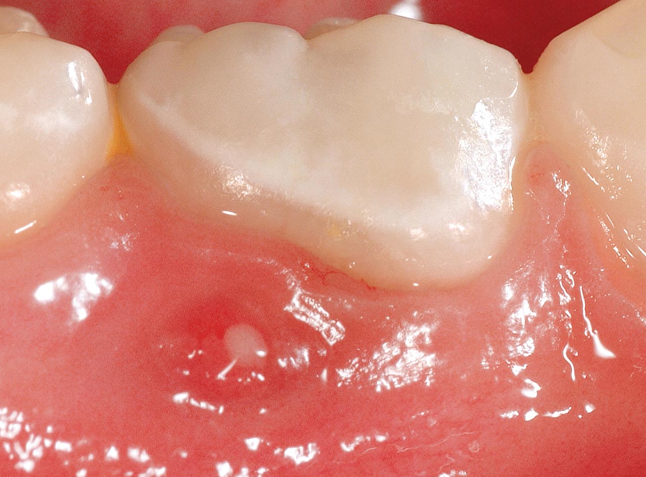 Abb. 6c und d: ... oder einer akuten Entzündung aufweisen können. Die Extraktion dieser Zähne ist immer das Vorgehen der Wahl.