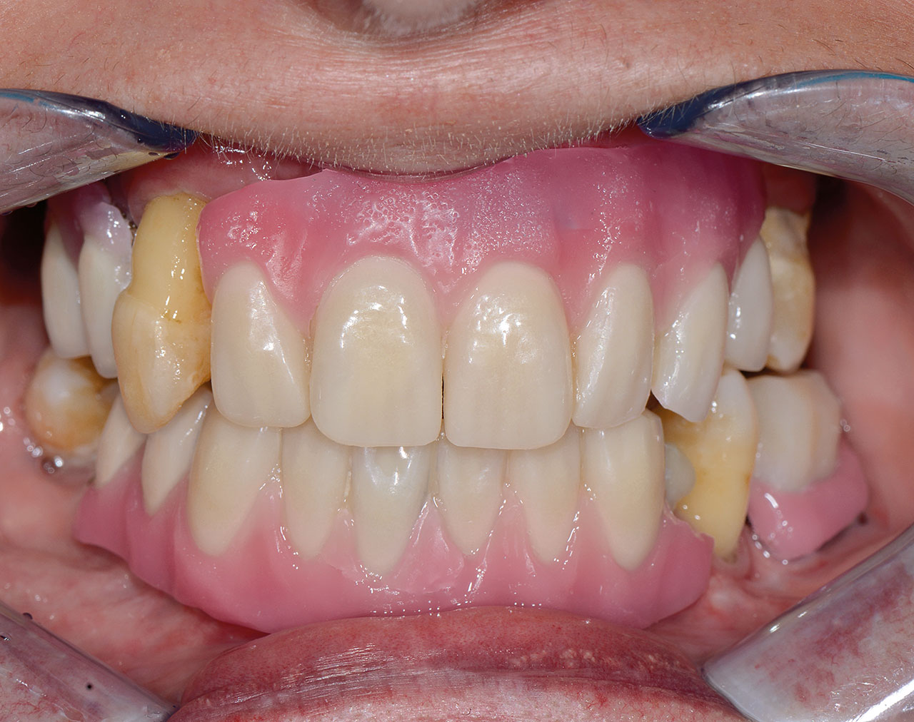Ästhetik-Einprobe im Mund der Patientin: Es werden gezielt Informationen über Zahnaufstellung und Volumen der Prothesenkörper gesammelt.