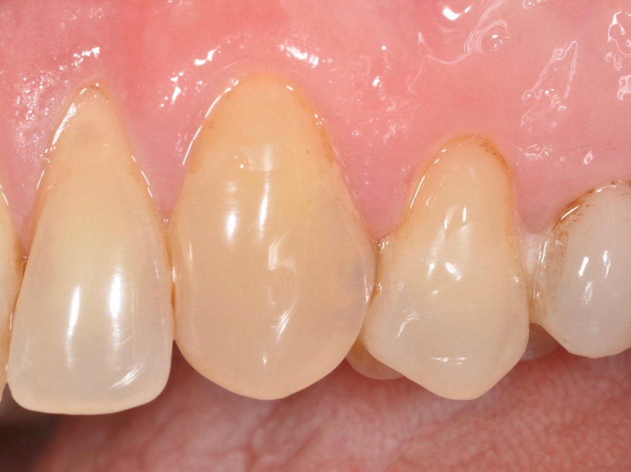 Zahn 23 (Restauration mit G-Bond) und Zahn 24 (Restauration mit Optibond FL) nach 9 Jahren.