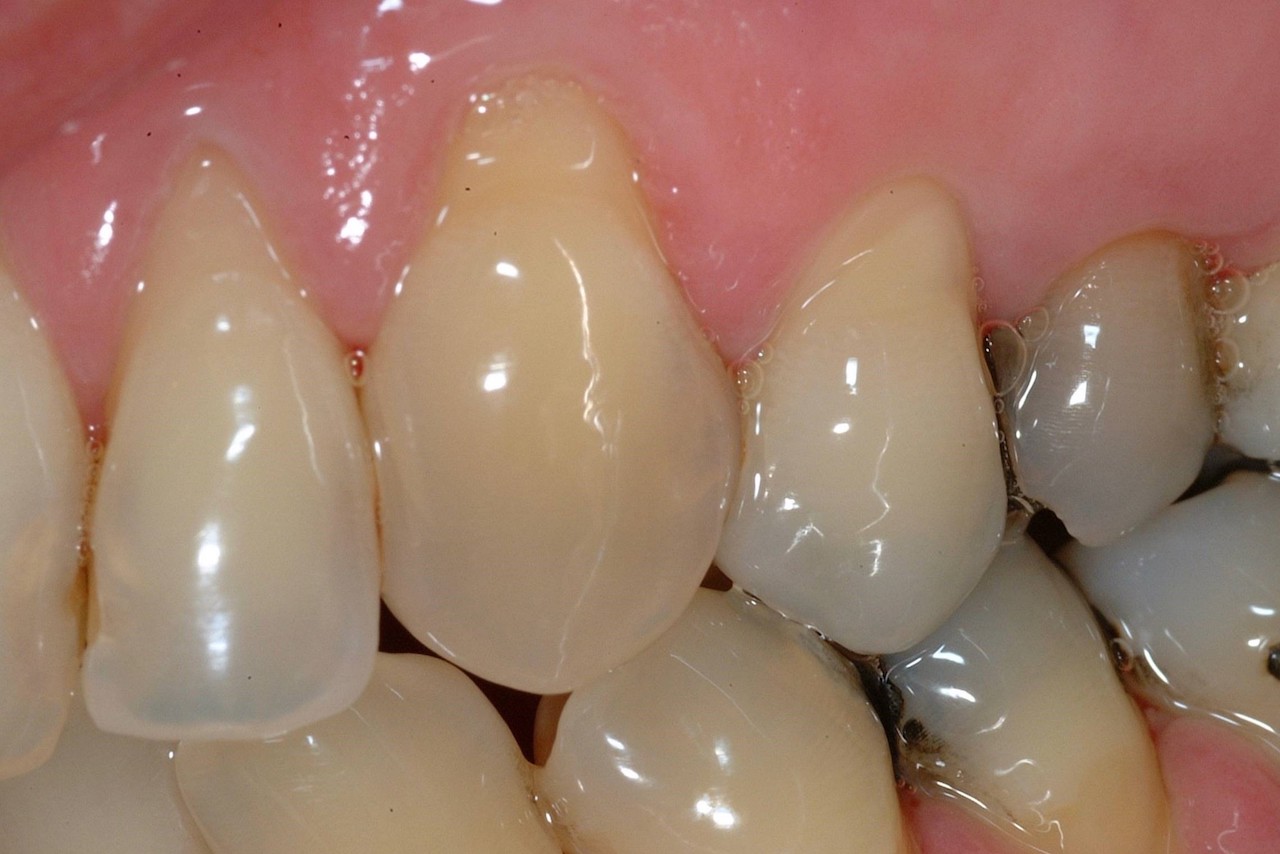 Zahn 23 (Restauration mit G-Bond) und Zahn 24 (Restauration mit Optibond FL) zu Untersuchungsbeginn.