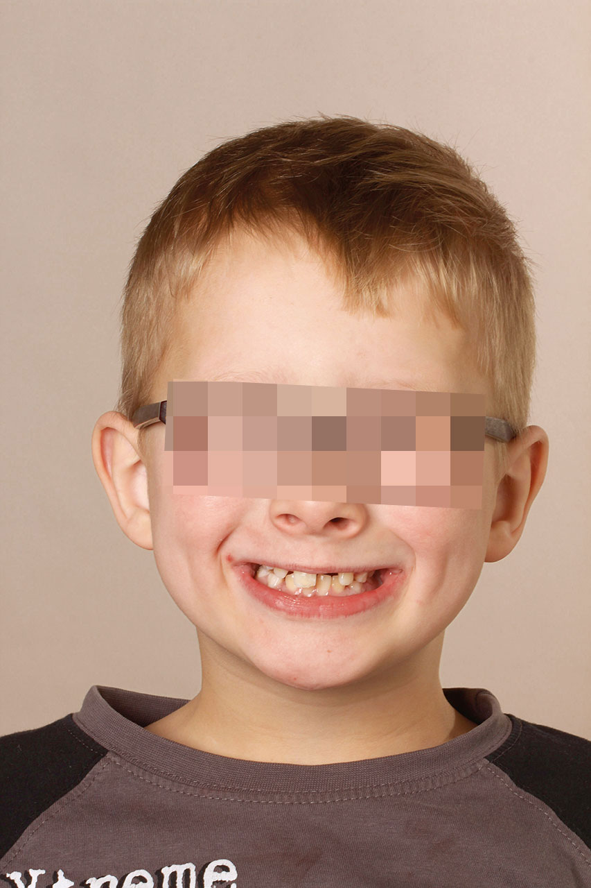 Abb. 1: Siebenjähriger Junge mit traumatischem Verlust von Zahn 21 etwa 6 Monate zuvor.