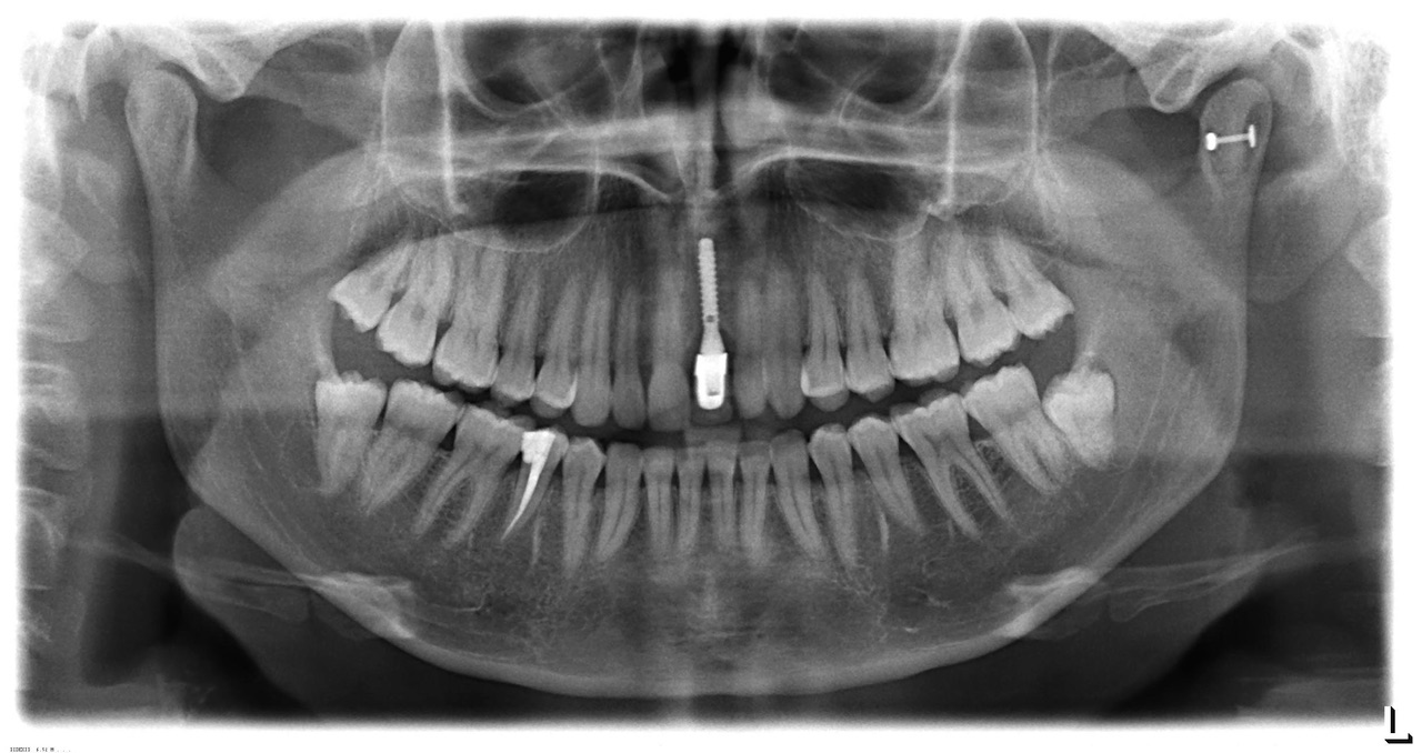 Abb. 1 und 2 Vertikale Veränderung der Nachbarzahn-Implantat-Relation im Erwachsenenalter: 1) Nach Implantatinsertion sind die natürlichen Zähne im Verlauf von 8 Jahren in Relation zum Implantat um ca. 2 mm eruptiert. (Quelle: Ludwig/Glasl, Implantologie 2018;26(2):125–132)