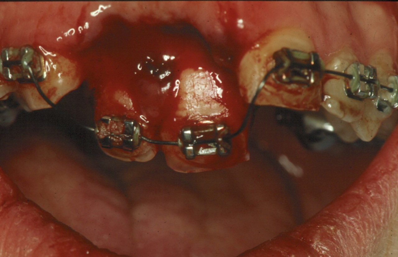 Abb. 1 Schweres Zahn-Kiefertrauma bei einem Jugendlichen mit festsitzender Zahnspange. Vollständige Luxation von zwei Frontzähnen, welche nur noch durch den kieferorthopädischen Draht im Mund gehalten werden. Die Zähne müssen schnellstmöglich replantiert und geschient werden. Bild: Dr. van Waes Uni Zürich