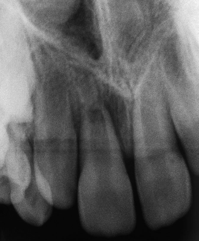 Abb. 2 Radiologischer Befund: Zahn 11 nach Schienenentfernung mit lateraler Aufhellung in Höhe des Frakturspaltes. Das apikale Fragment ist nur an den dünnen Dentinwänden zu erkennen.