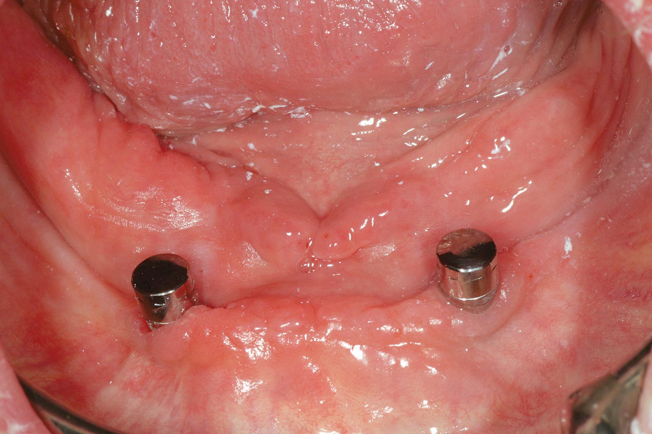 Abb. 7 Titanmagnetics-Inserts auf den zwei Tissue Level Implantaten.