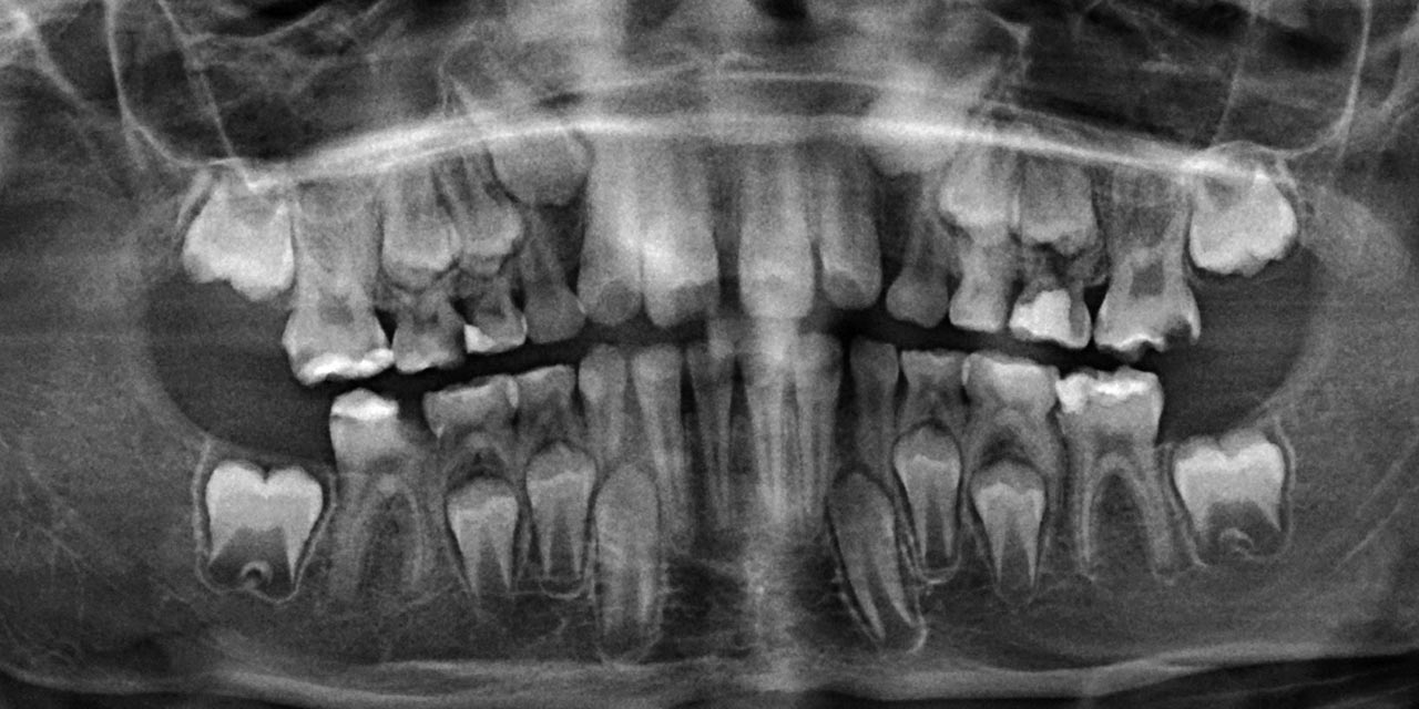 Abb. 2 Die Panoramaschichtauf­nahme unmittelbar vor der Sanierung in Intubationsnarkose zeigt ein teilweise saniertes Wechselg­ebiss. An den strukturgestörten bleibenden Molaren ist eine zum Teil fortgeschrittene Ausdehnung der Radioluzenzen pulpawärts zu erkennen. Im Milchgebiss sind die Zähne 55 und 64 (kariös) sowie der Zahn 65 (interradikuläre Aufhellung) als therapierelevant einzustufen.