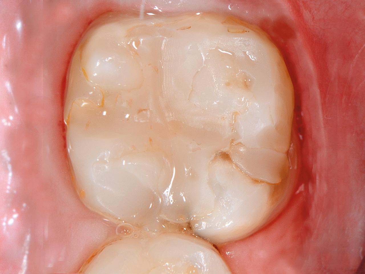 Abb. 7 Die Bilder dokumentieren am Beispiel des Zahns 36 die an allen bleibenden Molaren durchgeführten Behandlungsschritte. Die Ausgangssituation zeigt die großflächige Restauration mit einer mesialen Kavitation und einem insuffizienten Füllungsrand.