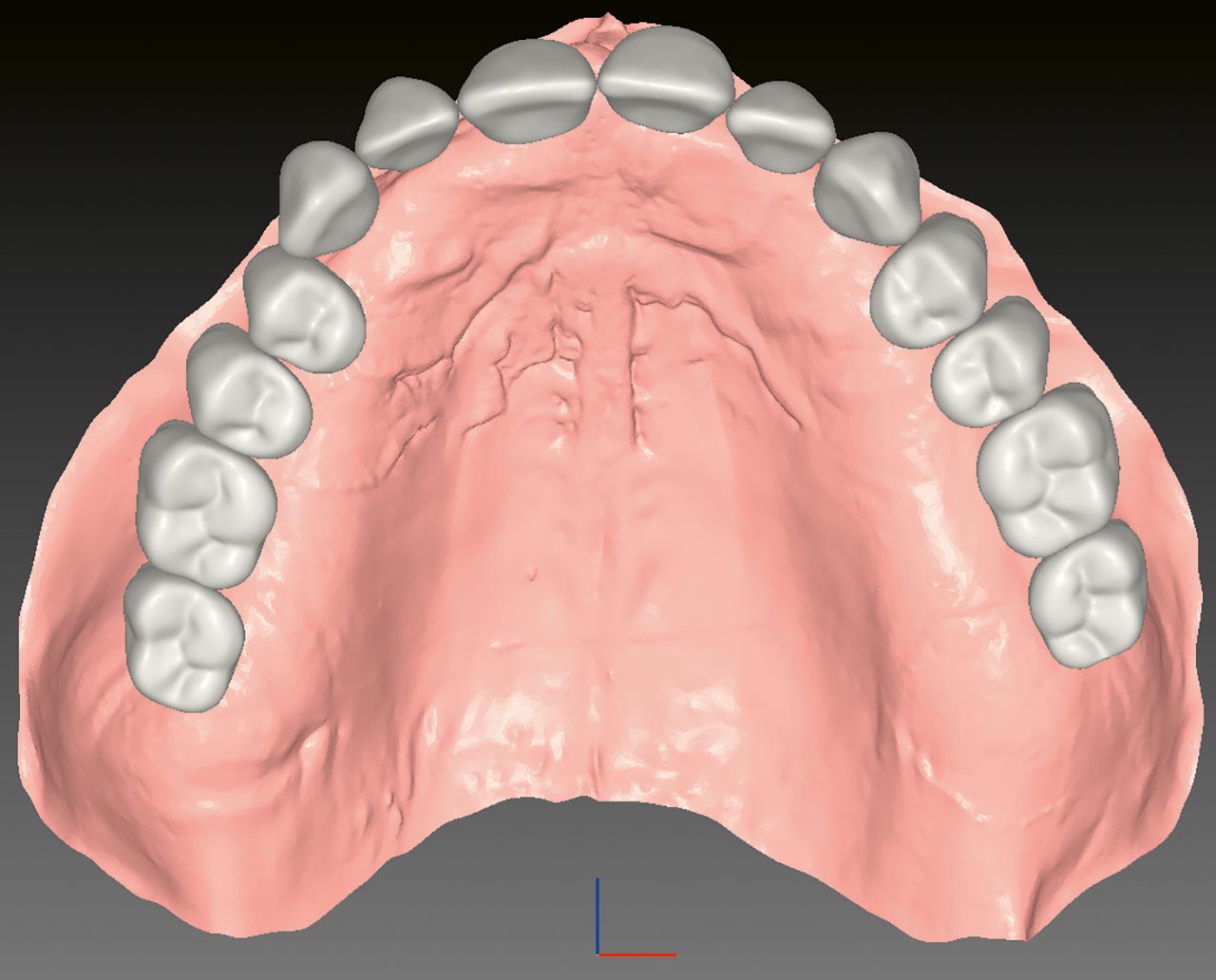 Abb. 4 Digitale Darstellung der Zahnreihen der Oberkieferaufstellung.