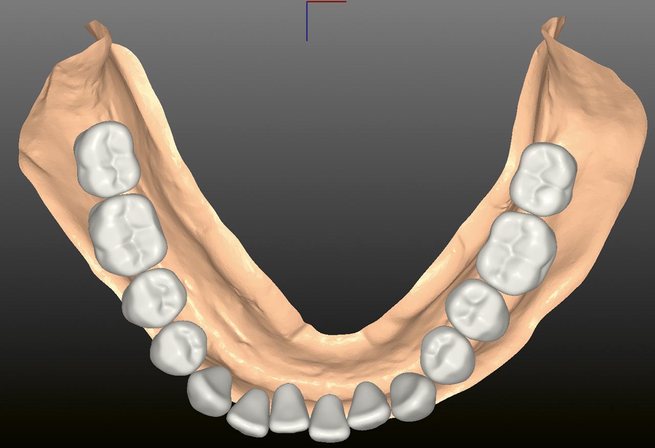 Abb. 5 Digitale Darstellung der Zahnreihen der Unterkieferaufstellung.
