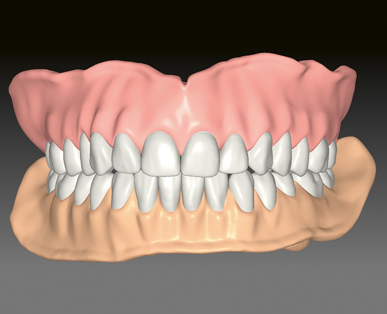 Abb. 8 Frontale Ansicht des digitalen Entwurfs der komplettierten Prothesen mit Zahnfleischstrukturen. 