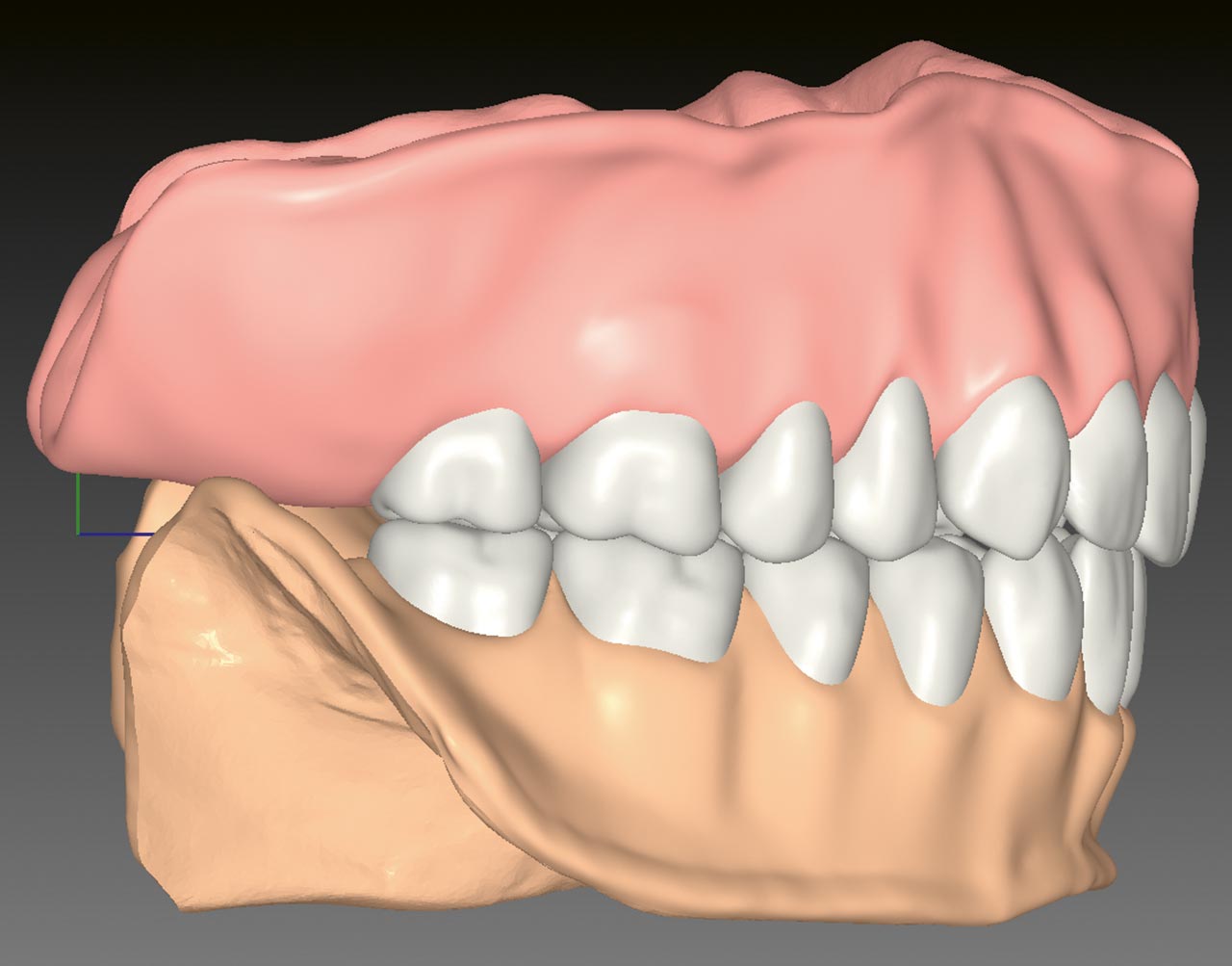 Abb. 9 Rechtsaterale Ansicht des digitalen Entwurfs der komplettierten Prothesen mit Zahnfleischstrukturen. 