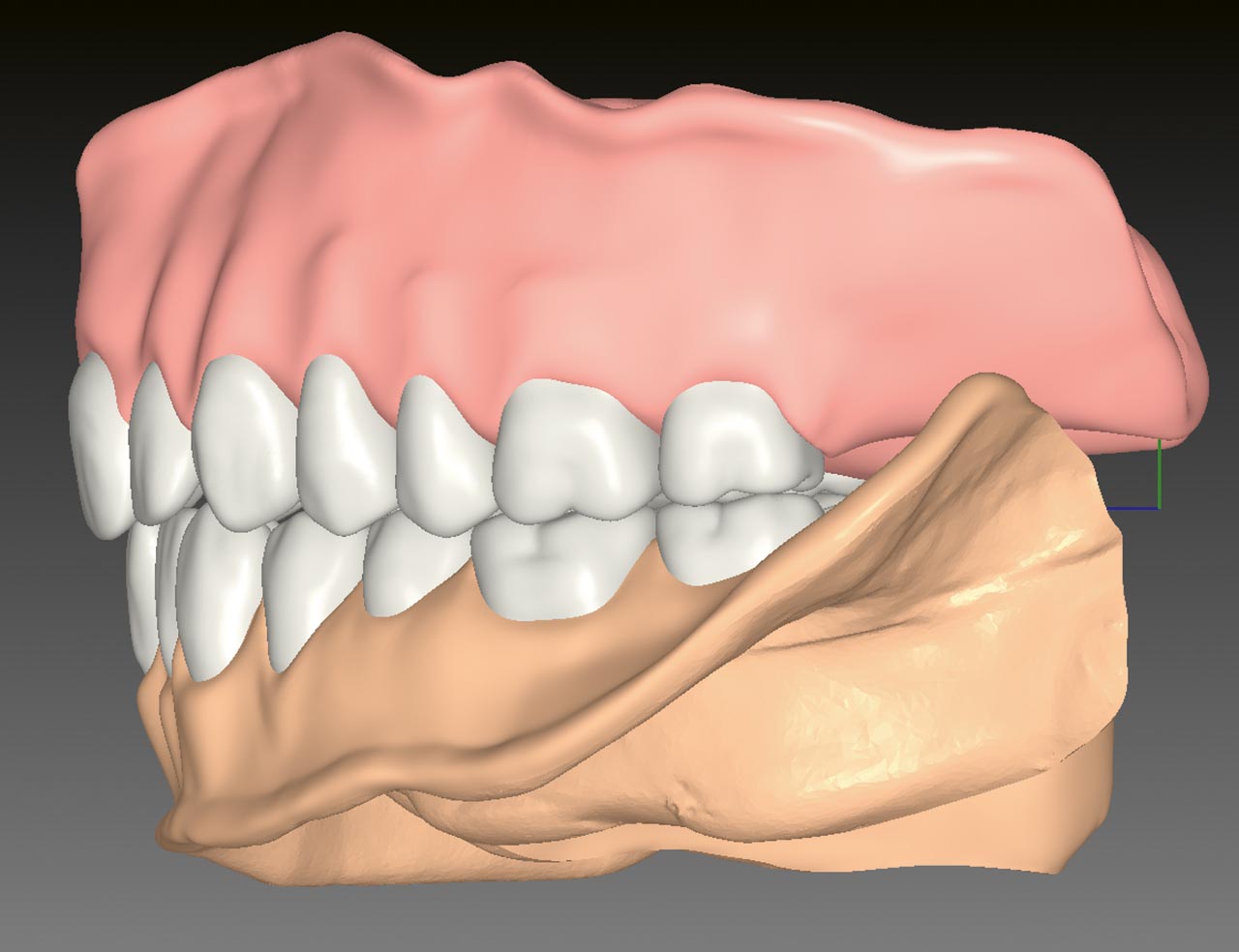 Abb.10 Linkslaterale Ansicht des digitalen Entwurfs der komplettierten Prothesen mit Zahnfleischstrukturen. 