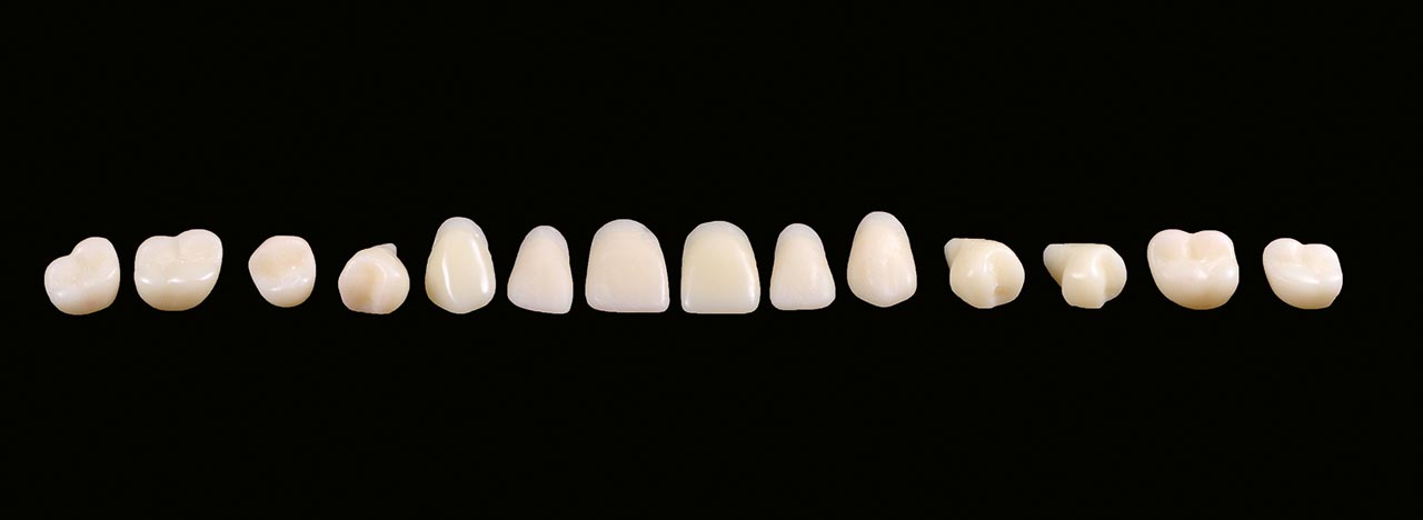 Abb. 33 Die individuell 3-D-gedruckten Oberkieferzähne.