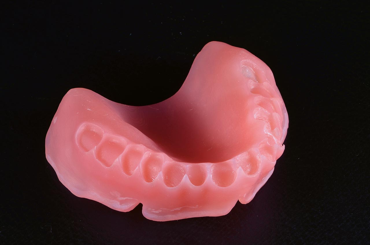 Abb. 34 bis 38 Die Oberkieferzähne werden für die Verklebung sukzessive einzeln auf die obere Prothesenbasis gesetzt.