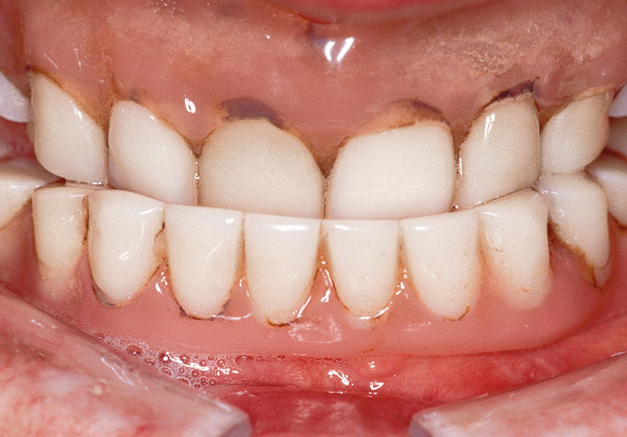 Abb. 13 Ausgangssituation: Basis inkongruent mit dem Tegument, künstliche Zähne stark abradiert, erheblicher Verlust an Vertikaldimension mit Altersprogenie, Funktionsrand defekt.