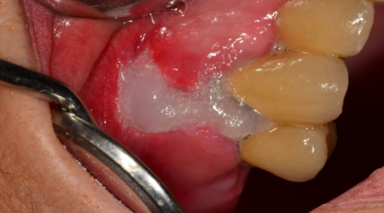 Behandlung mit BlueM Oral Gel (Foto: Block Veras)