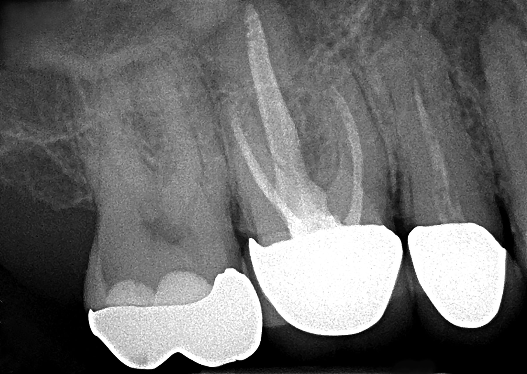 Abb. 1 Die Ausgangsaufnahme zeigt die insuffizienten prothetischen Restaurationen der Zähne 16 und 15 mit unterfüllten Wurzelkanälen.