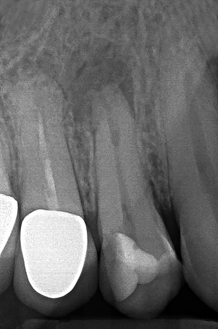 Abb. 2 Zahn 14 mit ausgeprägter Parodontitis apicalis und Verdacht auf eine damit verbundene Resorption.