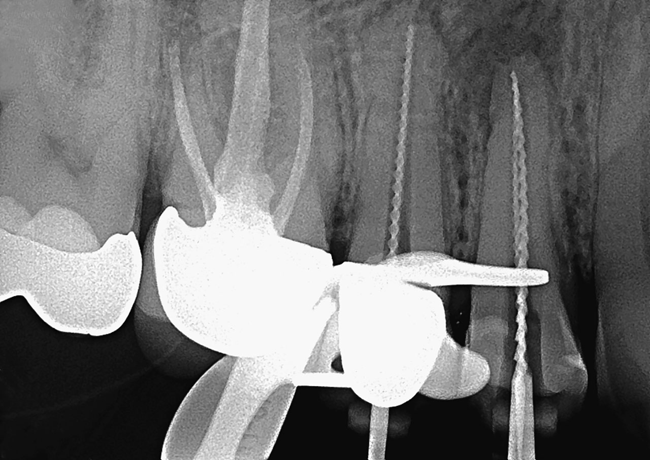 Abb. 4 Röntgen­kontrast­aufnahme der Zähne 14 und 15. 