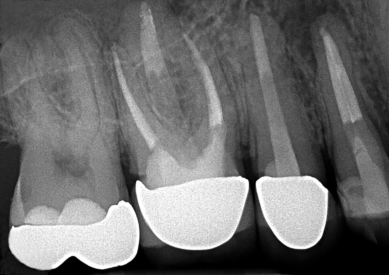 Abb. 5 Abschlusskontrolle der Wurzelfüllungen der Zähne 16, 15 und 14.