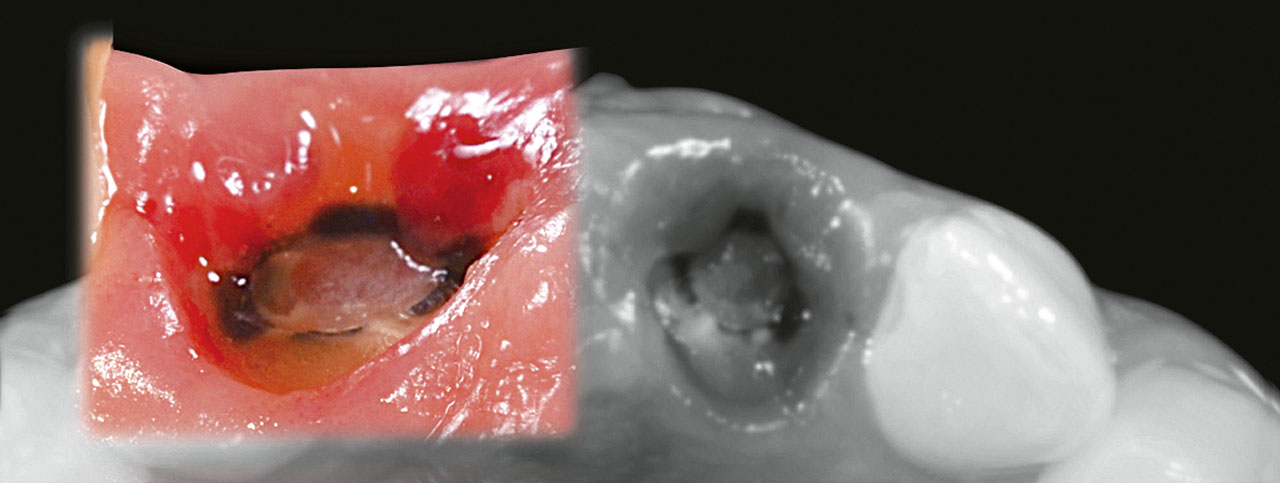 Abb. 12 Subgingivale Reduktion der Zähne um 1 bis 2 mm, um das Gewebe zu erhalten und die Versorgung mit Provisorien zu ermöglichen.