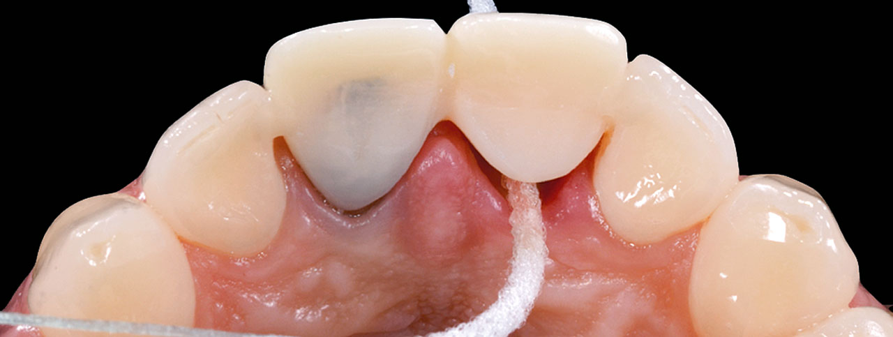 Abb. 13 Die Provisorien für die oberen mittleren Schneidezähne ermöglichten eine optimale Mundhygiene.