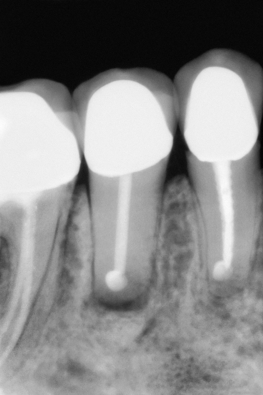 Abb. 1 Die Einzelzahnaufnahme zeigt eine Parodontitis apicalis am resezierten Zahn 45. Die orthograde Wurzelkanalfüllung stellt sich in dem Röntgenbild wandständig dar. Der Zahn ist mit einer retrograden Wurzelkanal­füllung versehen