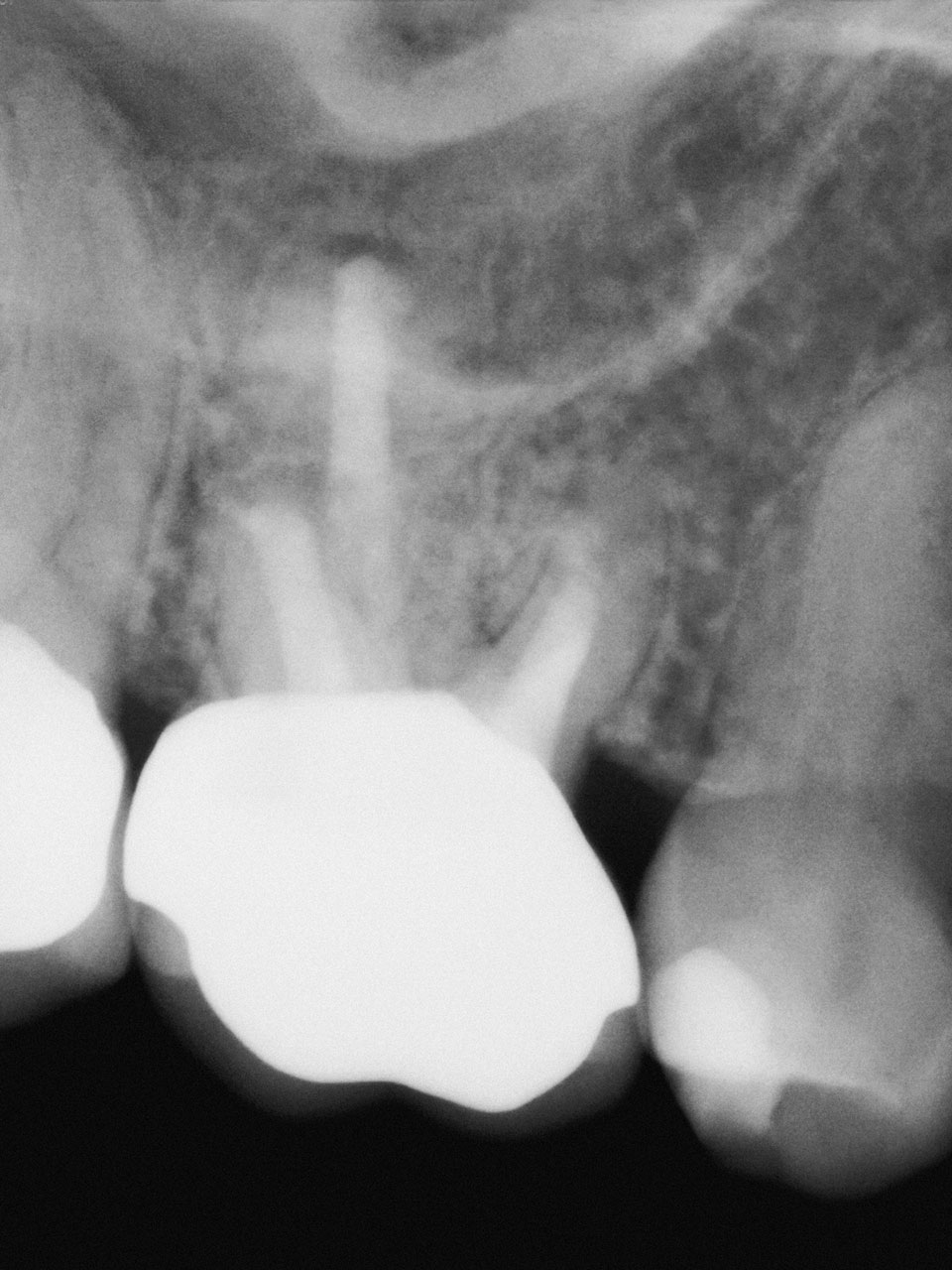 Abb. 7 Die radiologische Nach­kontrolle nach 3 Jahren deutet auf eine zeitlich regelrechte Heilung der apikalen Parodontitis hin. Der Zahn ist beschwerdefrei