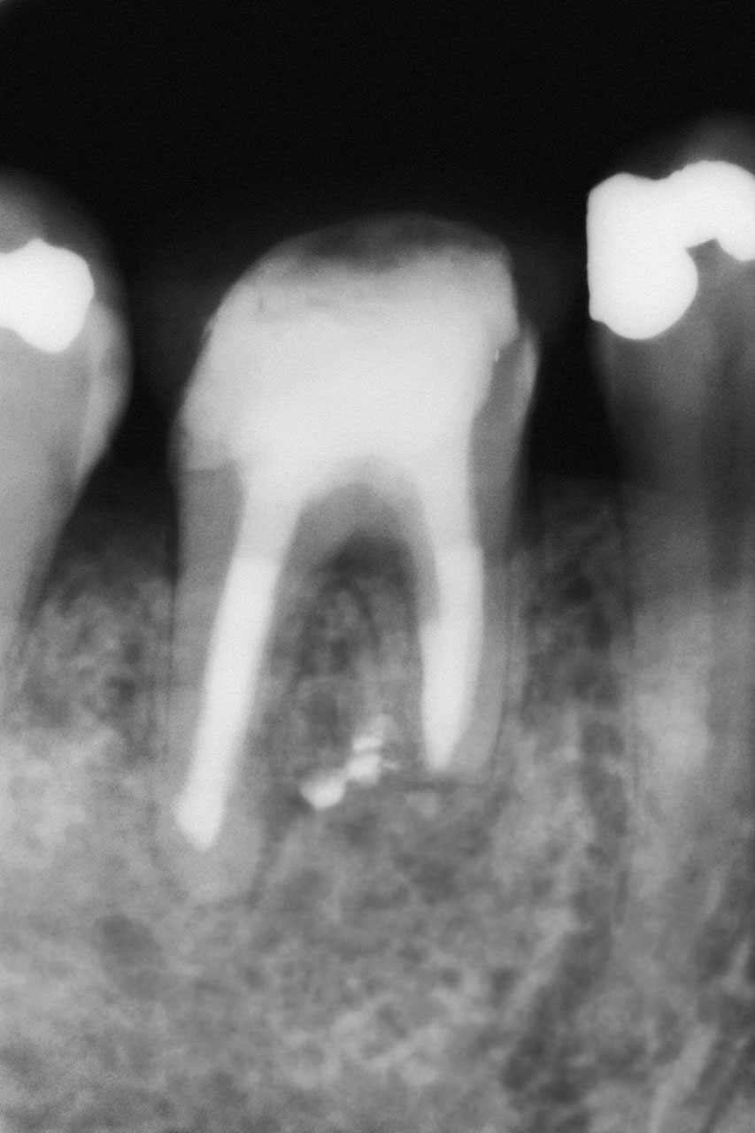 Abb. 10 Bereits  8 Monate nach Abschluss der orthograden Revisionsbehandlung lässt sich radiologisch eine deutliche Reossifika­tion des periradikulären Knochens darstellen. Der Zahn ist beschwerde­frei und ohne pathologische klinische Befunde