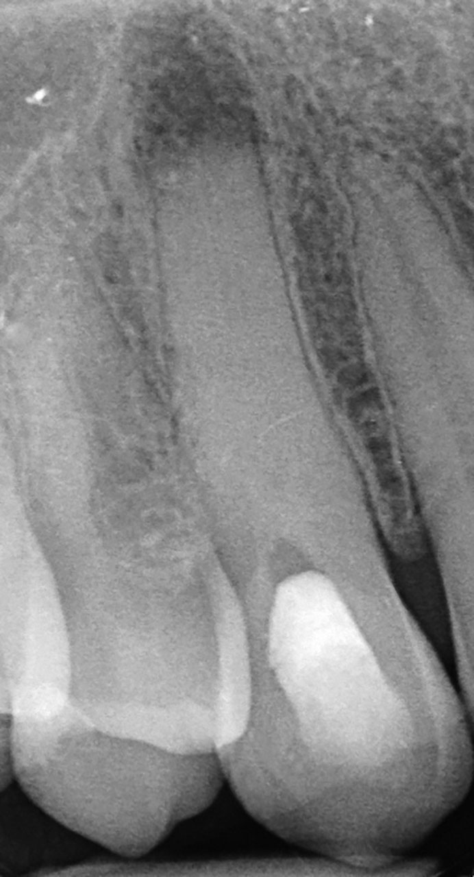 Abb. 1 Zahn 13 mit obliteriertem und nicht erschlossenem Wurzelkanal sowie Zustand nach apikal-­chirurgischem Eingriff.