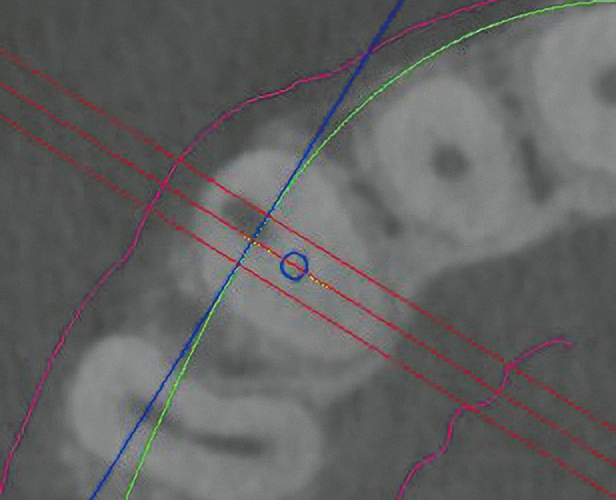 Abb. 4 Lagebestimmung des Wurzelkanals von Zahn 13 (blauer Kreis) in axialer DVT-Ebene.