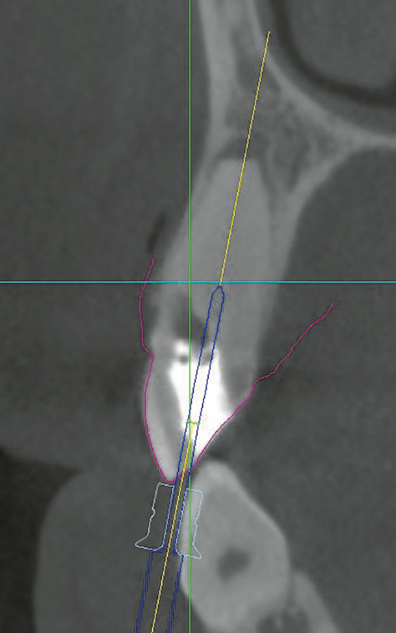 Abb. 5 Ausrichtung des Trepanationsbohrers (dunkelblau) in der Achse des Wurzelkanals (gelbe Linie) in sagittaler DVT-Ebene.