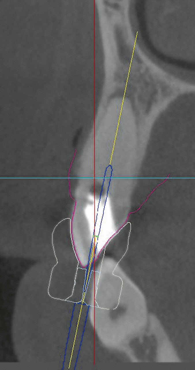 Abb. 10 Lage der konstruierten Schablone (weiß) mit Bohrhülse (hellblau) und Trepanationsbohrer (dunkelblau) zur Zahnkrone in sagittaler DVT-Ebene.