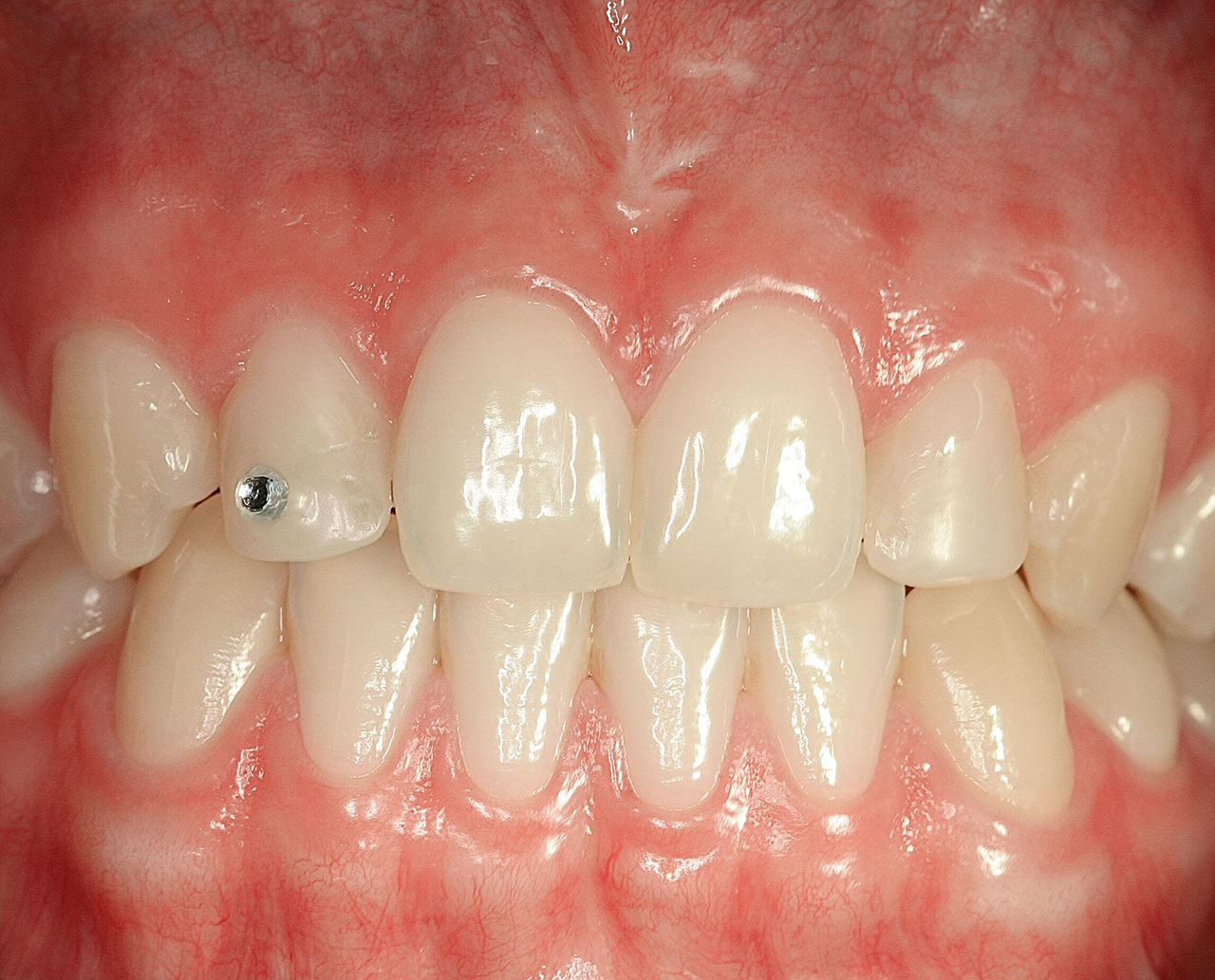 Abb. 1 Klinisch entzündungsfreie Gingiva (Pat. weiblich,  17 Jahre): Es liegen keine Zahnhälse frei.