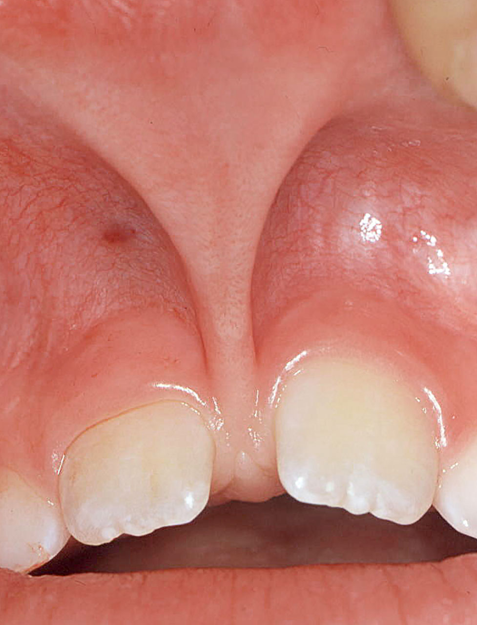 Abb. 5 Approximal der Zähne 11 und 21 marginal einstrahlendes Oberlippenbändchen.
