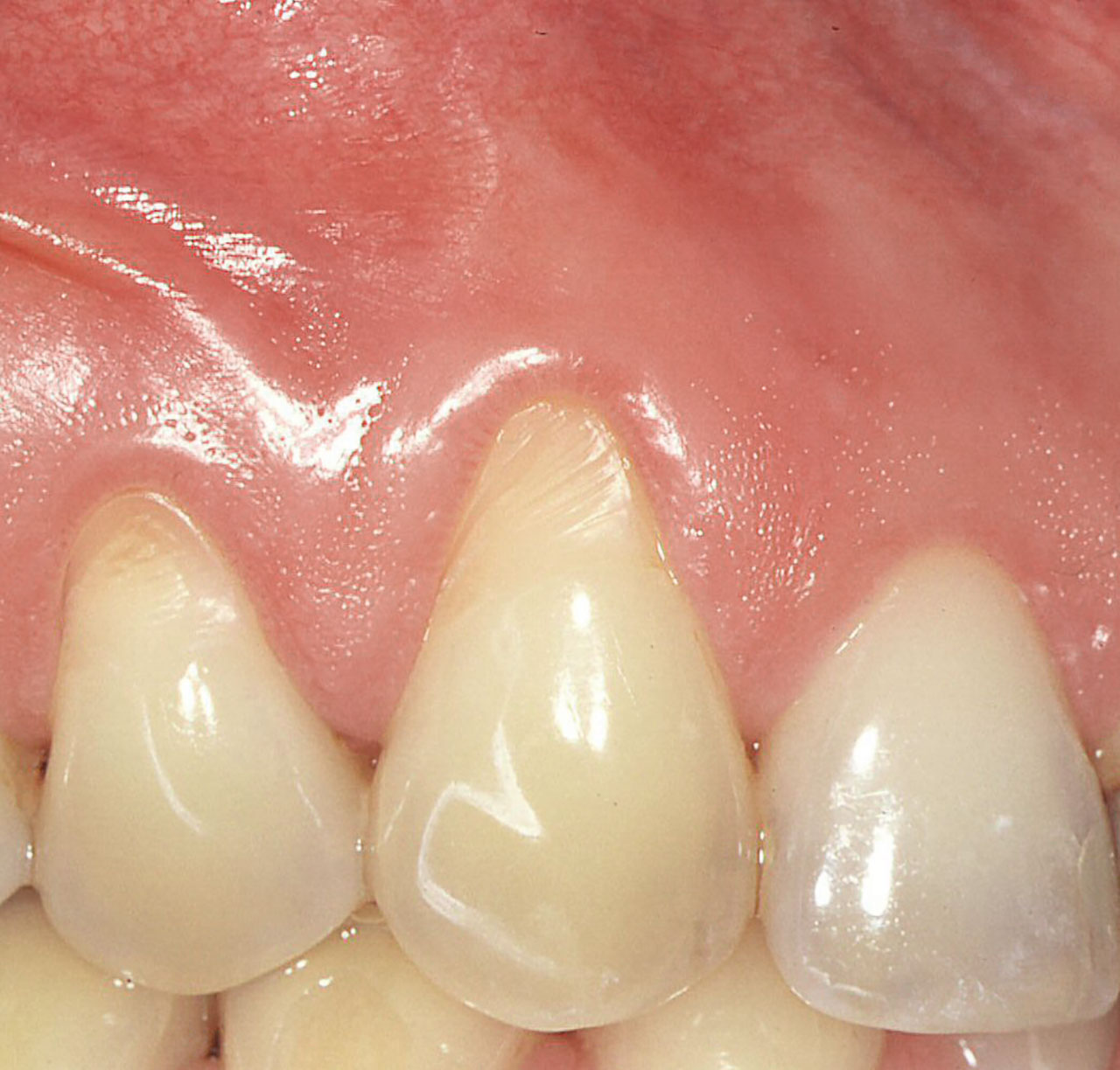 Abb. 6  Faziale Rezession an Zahn 13 mit schmalem Band keratinisierter Gingiva und horizontalen Rillen auf dem freiliegen- den Zahnhals. An Zahn 12, der keine Rezession aufweist, findet sich ein deutlich breiterer Saum keratinisierter Gingiva. Es ist sehr wahrscheinlich, dass an Zahn 13 vor Entste­hung der Rezession ein ähnlich breiter Saum keratinisierter Gingiva existierte.
