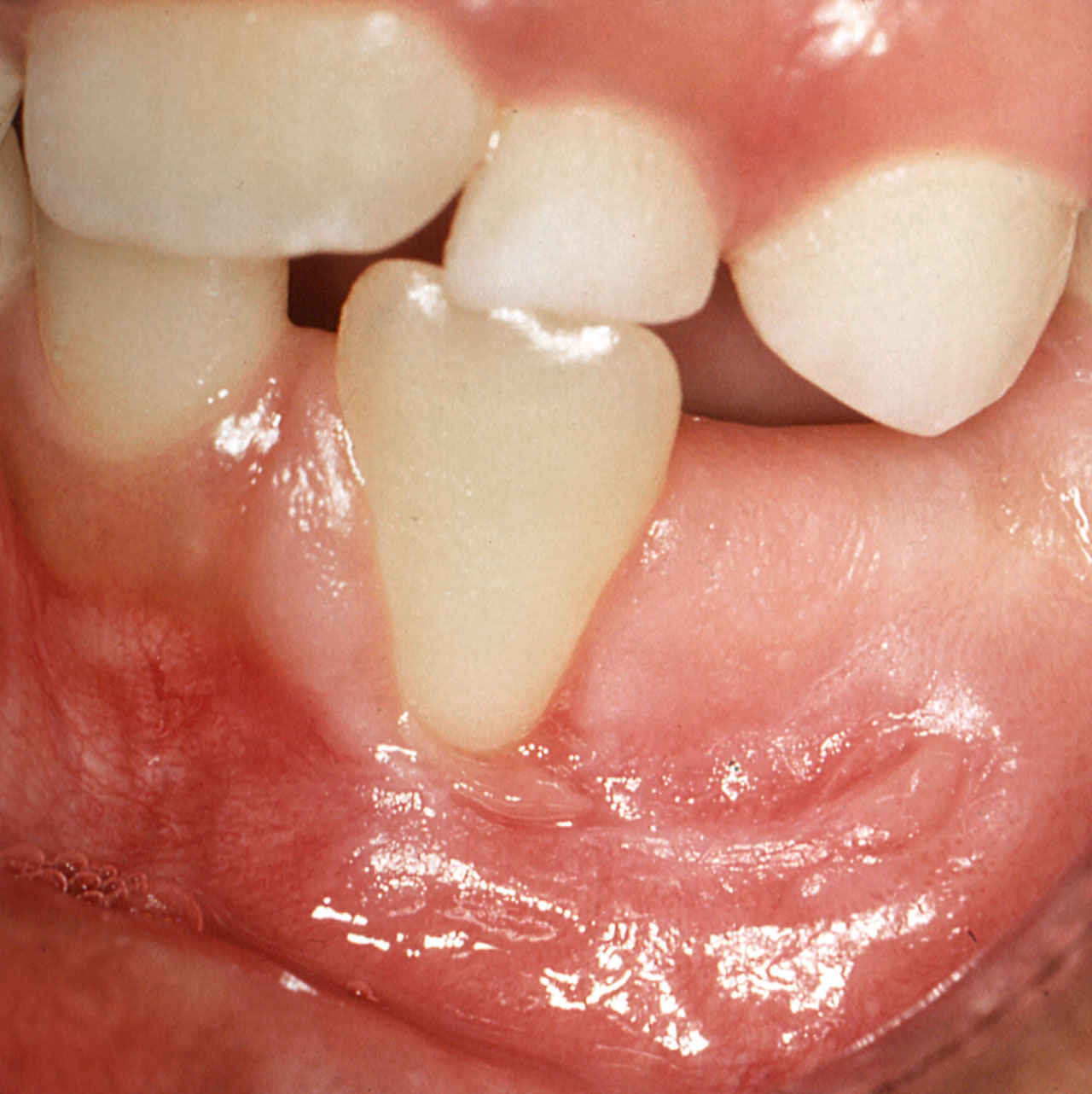 Abb. 8 Rezession bis zur Schmelz-Zement-Grenze an Zahn 32; an Zahn 31 liegt der Gingivarand deutlich weiter koronal, Zahn 33 ist noch nicht durchgebrochen, die Schleimhaut des zahnlosen Alveolar- fortsatzes weist eine horizontale Vernarbung auf.