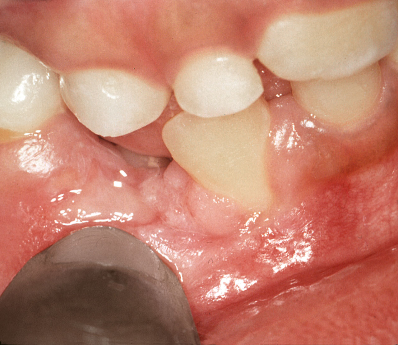 Abb. 9 Kontralateral an Zahn 42 und der benachbarten Schleimhaut passt der Fingernagel des Patienten exakt in die Vernarbung (b). Manipulation mit dem Fingernagel an Gingivarand und Alveolarfortsatz erscheint als plausible Ursache der Rezessionen.