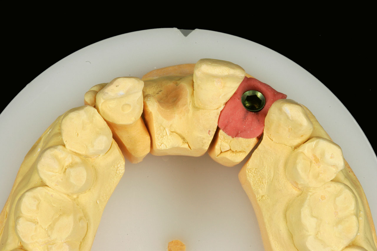 Abb. 3 Gipsmodell mit palatinaler Veneer-Präparation an Zahn 13, Schaltlücke in Regio 12/11 und Laborimplantat in Regio 22.