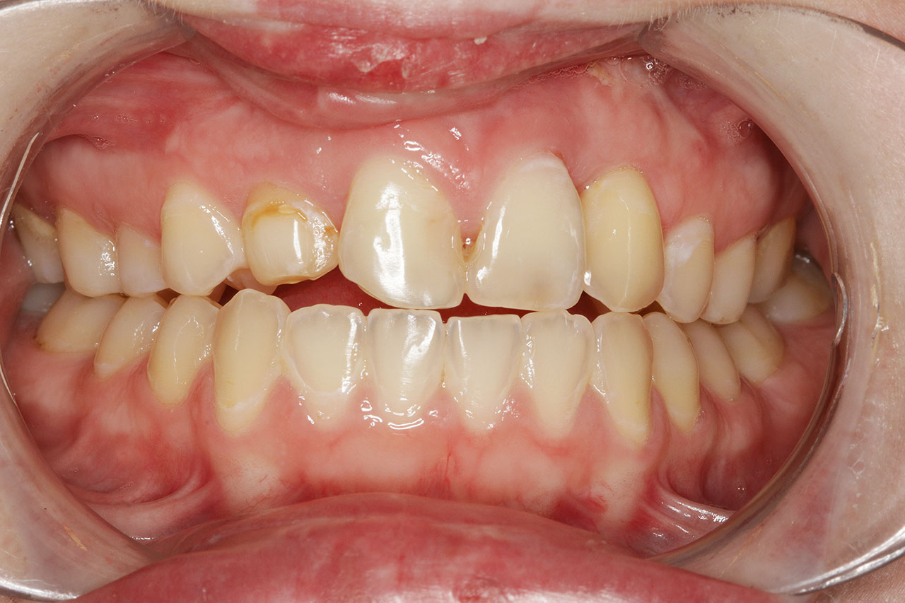Abb. 18 Ausgangssituation von frontal vor Extraktion des Zahns 21.