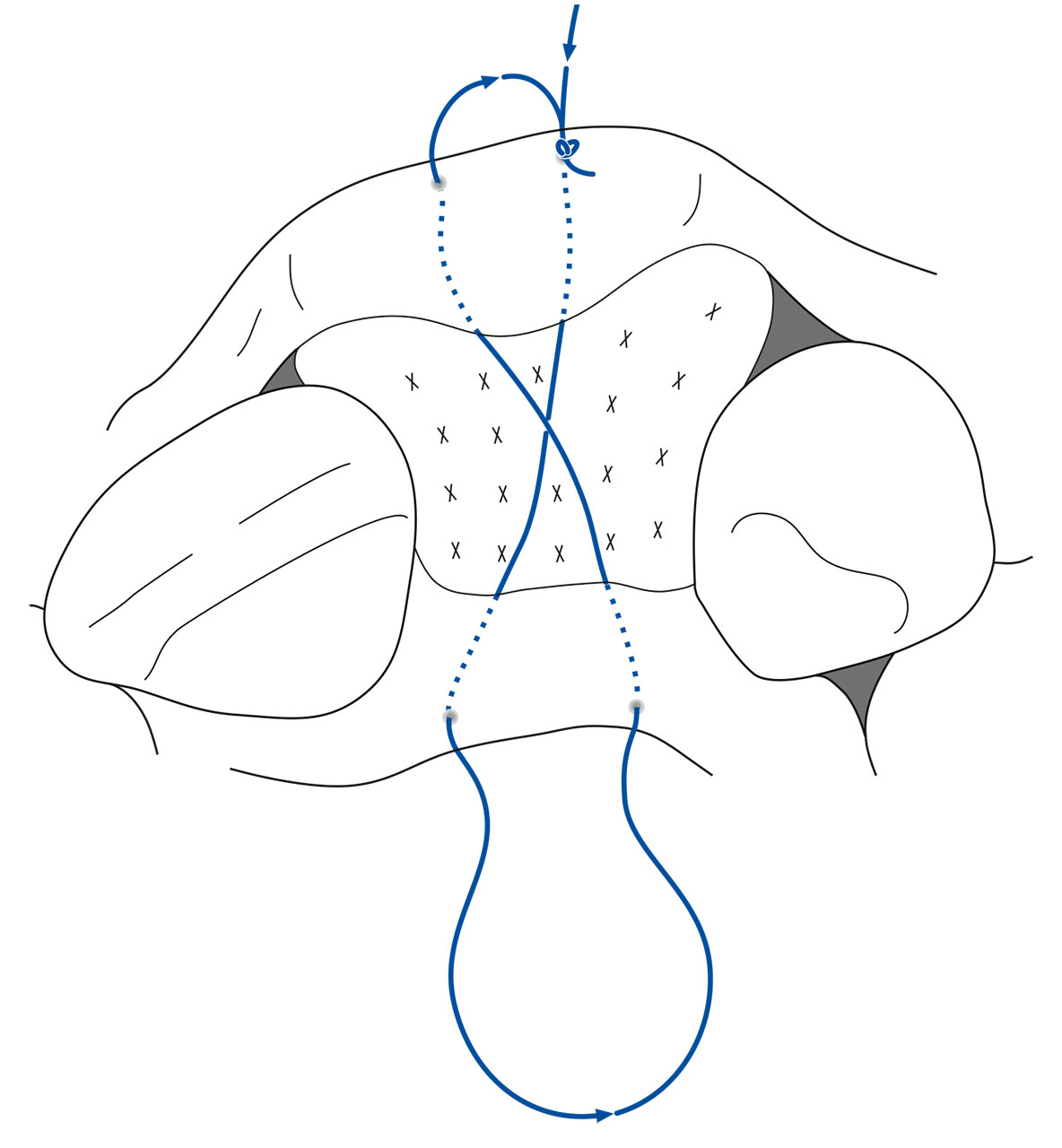Abb. 5 Schematische Darstellung einer horizontalen, intern verlaufenden, gekreuzten Matratzennaht von okklusal. 