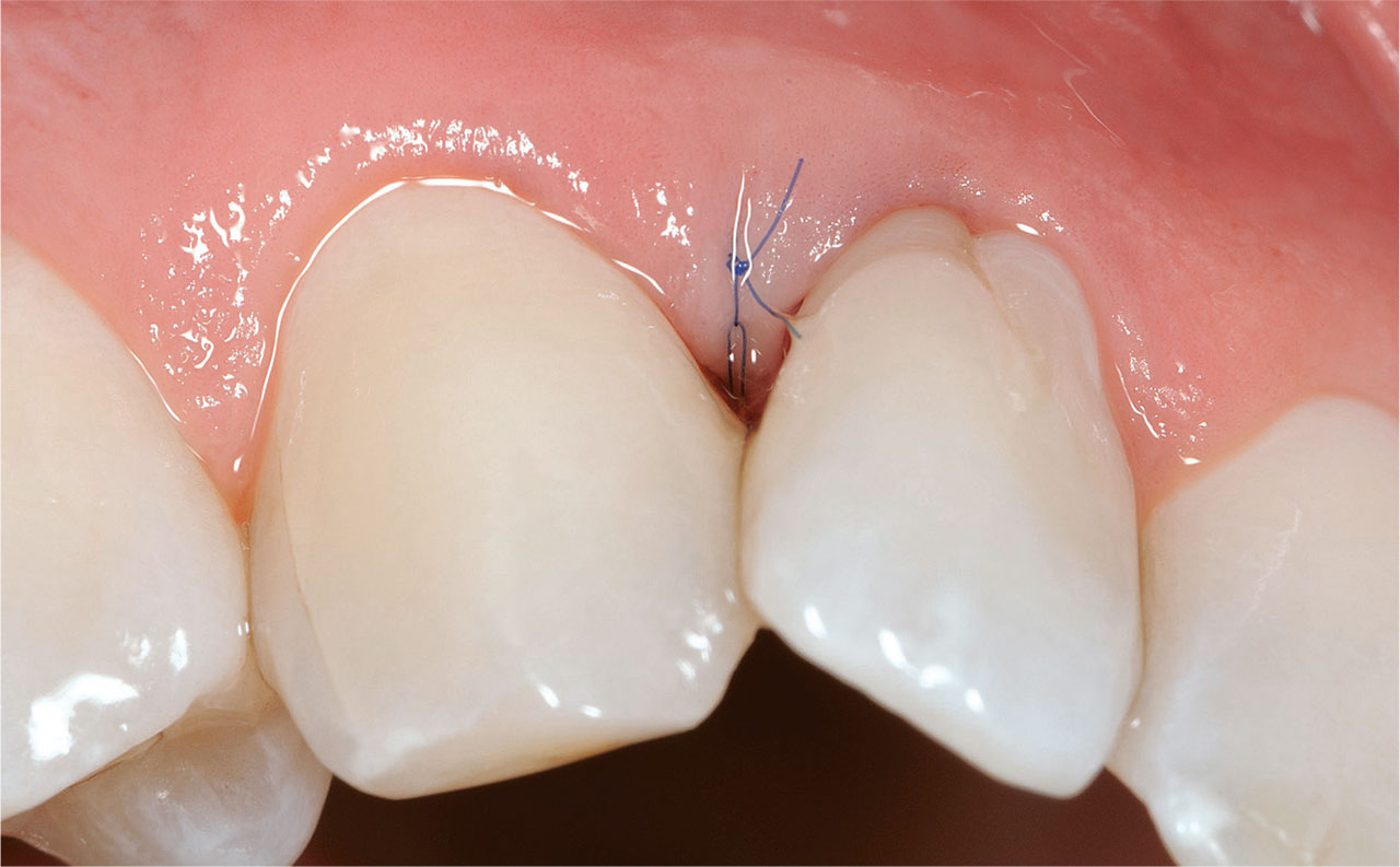 Abb. 7 Wundverschluss eines mikrochirurgischen Accessflaps nach regenerativer Parodontalbehandlung im Oberkiefer Frontzahnbereich durch eine Einzel­schlingnaht. Als Nahtmaterial wurde Seralene DS15 in der Stärke 7-0 verwendet. 