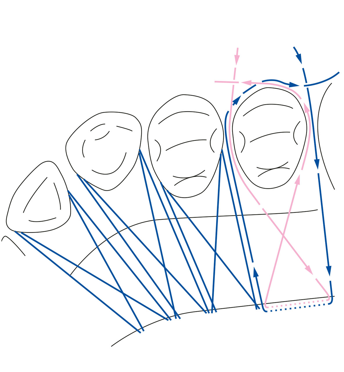 Abb. 15 Schematische Darstellung einer parallelen und einer gekreuzten horizontalen „double crossed suture“ von okklusal.