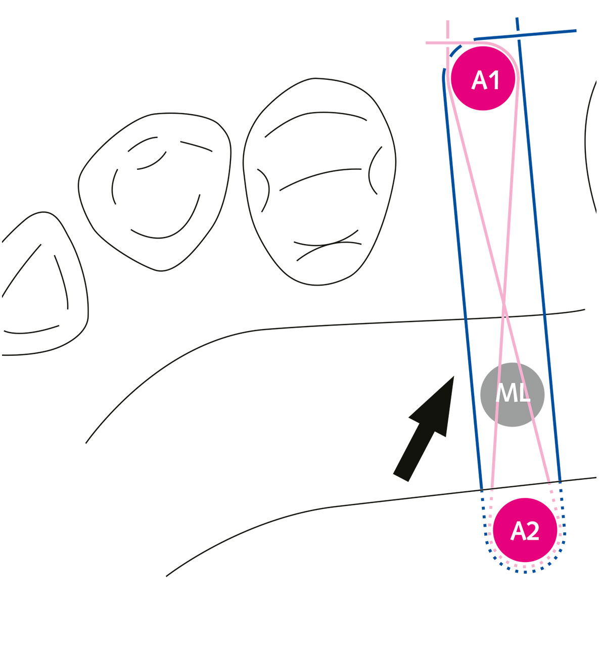 Abb. 16 Schematische Darstellung der Lappenstabilisierung (Pfeil) durch eine parallele und eine gekreuzte horizontale „double crossed suture“. Zahn und mastikatorische Gaumen­mukosa fungieren als Anker (ML = mobiler Lappen, A1 = Anker 1, A2 = Anker 2).