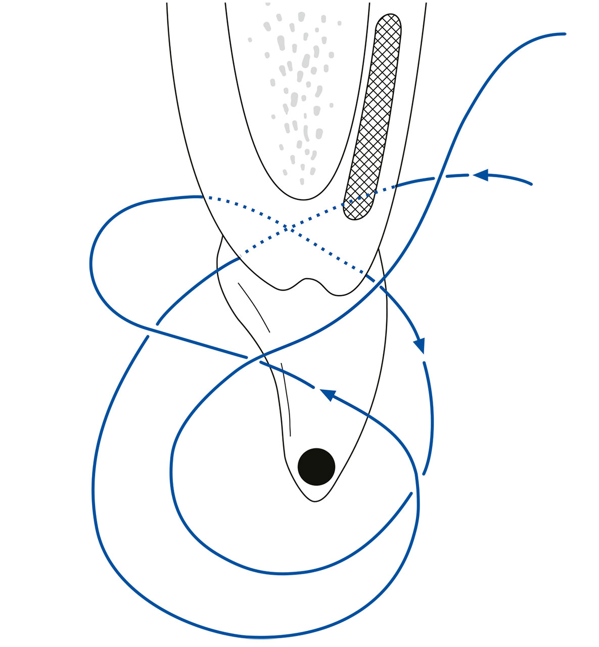 Abb. 19 Schematische Darstellung der Vorgehensweise beim Legen einer vertikalen „double crossed suture“ aus sagittaler Perspektive.